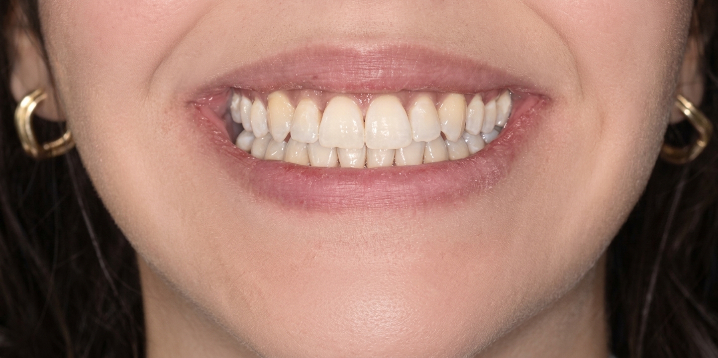 Sourire après un traitement d'orthodontie au cabinet du Dr Avramoff